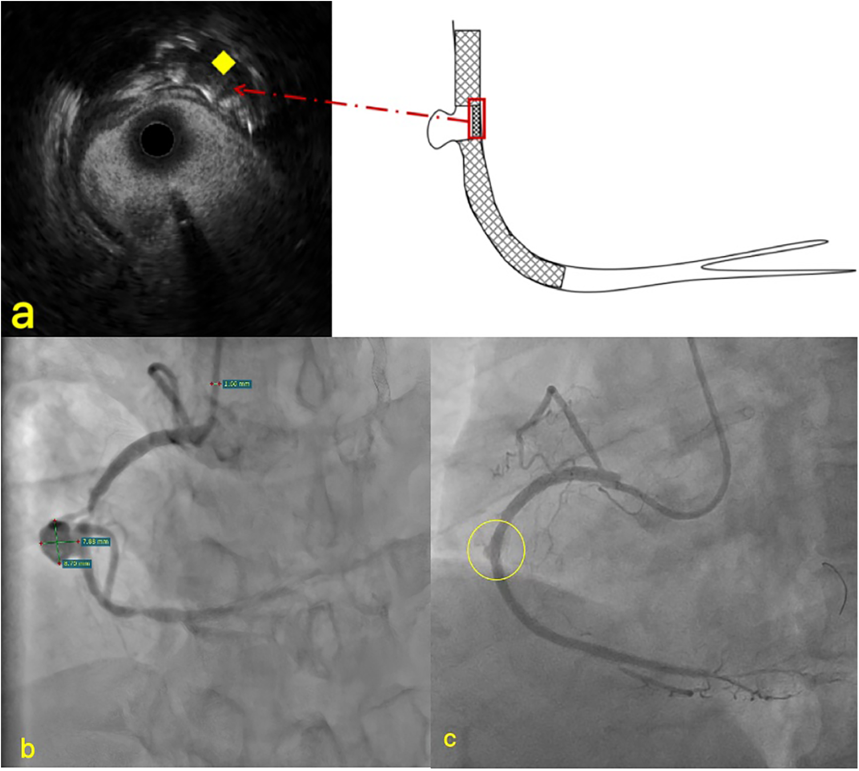 Panel a shows an intravascular ultrasound image with an annotated structure, alongside a diagram of a stent placement. Panel b displays a coronary angiogram highlighting vessel dimensions. Panel c shows a follow-up angiogram with a circled area of interest.