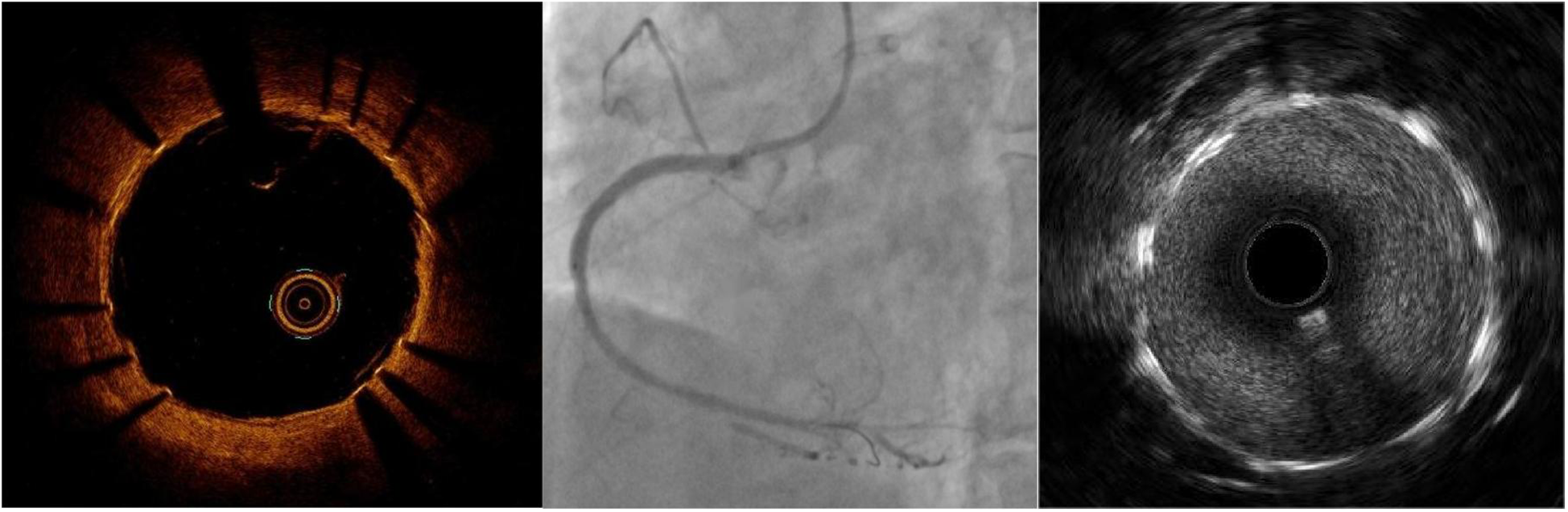 From left to right: an optical coherence tomography scan showing a circular structure with orange hues, an angiogram depicting a coronary artery highlighted against a gray background, and an intravascular ultrasound image displaying a circular, textured pattern with varying shades of gray.