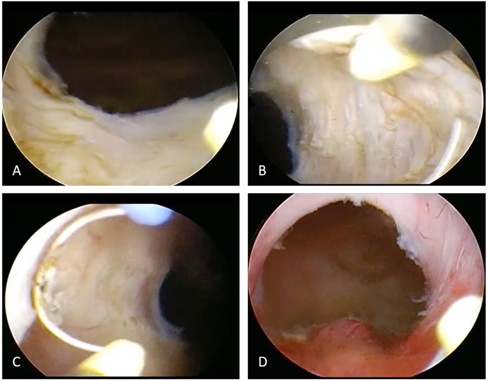 Four endoscopic images labeled A to D depict different stages of tissue examination. A shows initial tissue assessment. B displays the start of a procedure. C shows a closer view with an instrument visible. D presents a wide view of the tissue after further manipulation.
