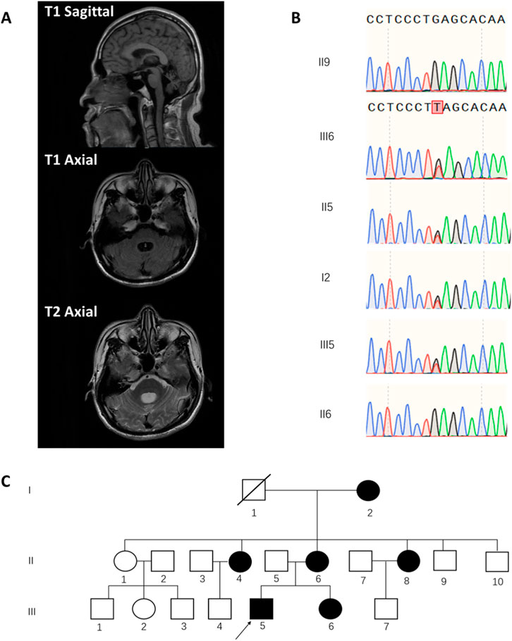 MRI images in section A show brain scans: a T1 sagittal and axial view, and a T2 axial view. Section B features DNA sequence chromatograms with genetic variations marked. Section C presents a heredity diagram, depicting a family tree with individuals indicated by squares and circles, some filled and some unfilled, representing different genetic traits.