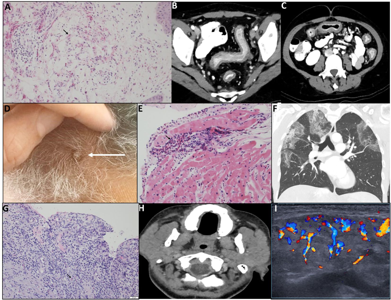 Panel A shows a histology slide with pink and blue staining patterns. Panel B is an axial abdominal CT scan displaying internal organs. Panel C also shows an axial abdominal CT with different organ visibility. Panel D depicts a close-up of a scalp with a hand parting gray hair, highlighting a spot with an arrow. Panel E presents a histological section with pink and blue stained tissue. Panel F is a CT scan of lungs showing detailed structures. Panel G displays a histology slide with a tissue sample. Panel H is an axial CT scan of the neck. Panel I exhibits a color Doppler ultrasound image.