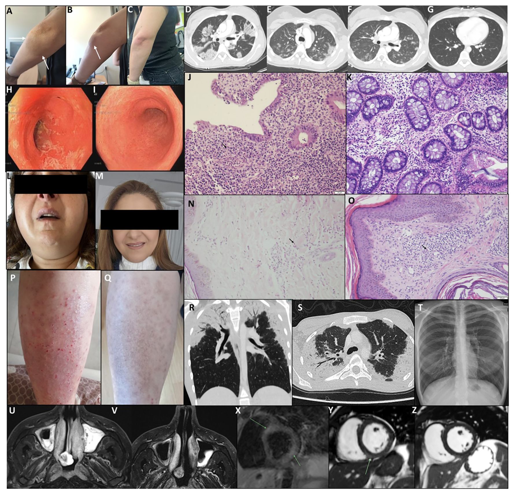 A variety of medical images depicting different diagnostic tests and conditions. Panels A to C show arms with skin conditions. Panels D to G display chest CT scans. Panels H and I show endoscopic views of the gastrointestinal tract. Panels J to O feature histological images with varying tissue structures. Panels L and M show facial images with blacked-out eyes for anonymity. Panels P and Q portray legs with skin conditions. Panels R to T exhibit lung CT scans and a chest X-ray. Panels U to Z include MRI images of the nasal region and heart.