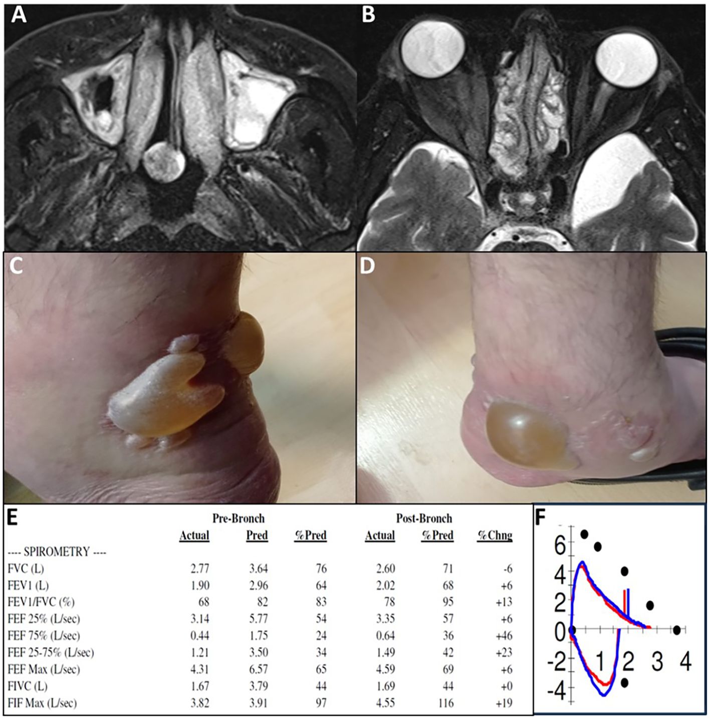 Panel A and B show MRI images of a pelvic region with differences in tissue density. Panels C and D depict a foot with large blisters on the heel. Panel E presents spirometry results comparing pre-bronchodilator and post-bronchodilator data, indicating various lung function measurements. Panel F contains a graph with plotted points and curves, likely illustrating spirometry data changes.