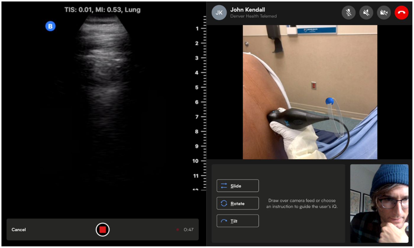 Ultrasound imaging interface showing a black and white scan of a lung on the left. On the right, a person uses an ultrasound probe on a patient's side while another person observes via video call.