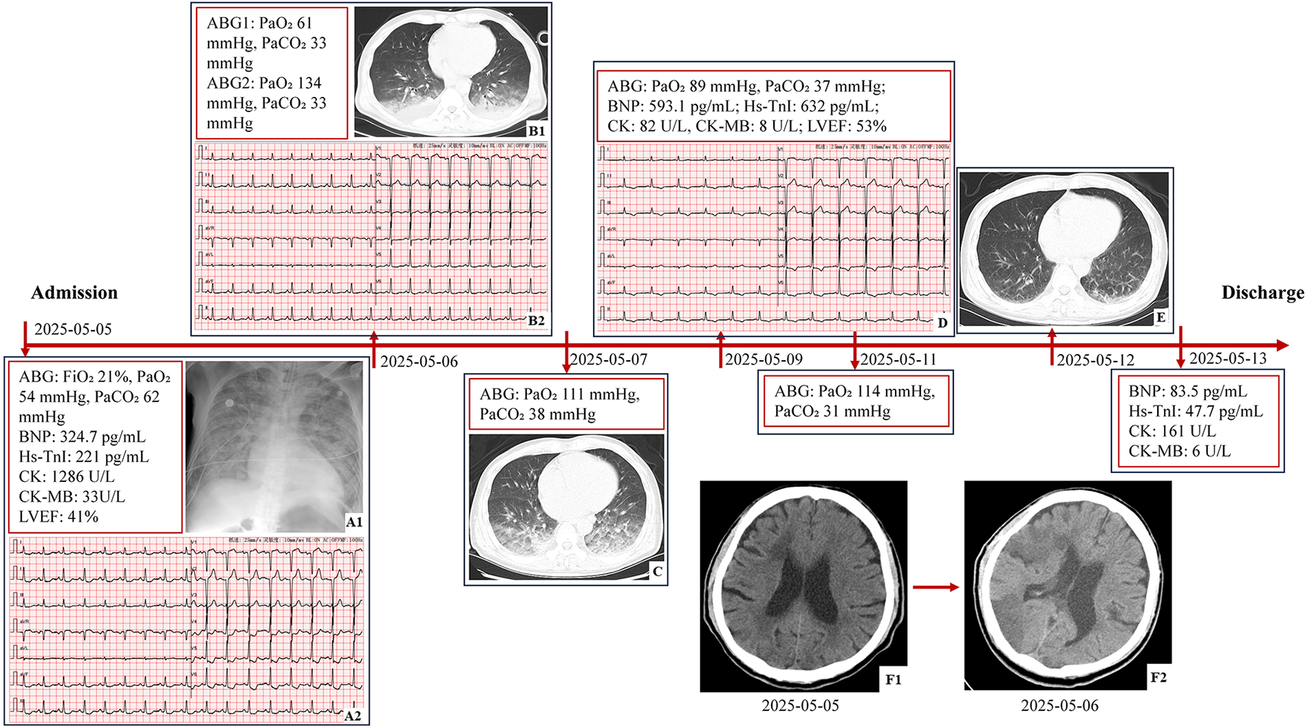Timeline of a medical case from admission on May fifth, two thousand twenty-five to discharge on May thirteenth. Includes chest X-rays and CT scans, blood gas analysis, and EKG results. Key data: PaO2, PaCO2, BNP, Hs-TnI, CK, CK-MB, and LVEF levels recorded on various dates, showing changes in the patient's condition. Images A1, B1, C, D, and E are CT scans or X-rays highlighting lungs and heart. Images F1 and F2 compare brain CT scans from two different dates.