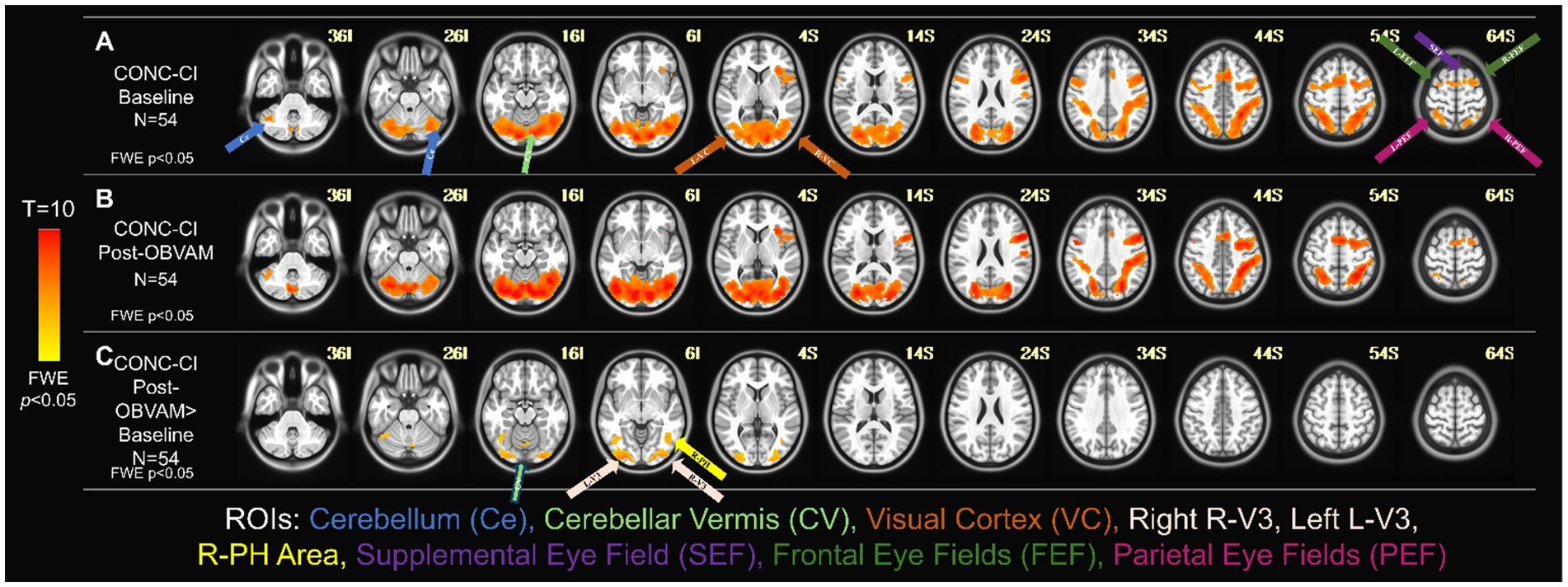 Three rows of brain scans labeled A, B, and C examine brain activity in different conditions with regions of interest highlighted in color. Row A shows baseline activity with orange areas in the visual cortex. Row B depicts post-OBVAM changes with similar regions highlighted. Row C displays post-OBVAM greater than baseline activity, showing less extensive highlighted areas. The accompanying legend identifies regions of interest, including the cerebellum, visual cortex, and eye fields, marked by various colored arrows. The significance level is fixed at Family-Wise Error rate less than 0.05.