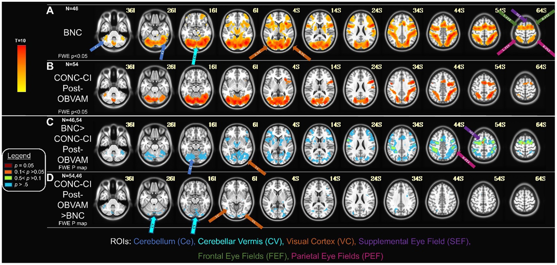 Brain scan images display four sets of comparisons: A) BNC group with orange and yellow highlights in various brain regions, B) CONC-CI Post-OBVAM group with orange highlights, C) BNC greater than CONC-CI Post-OBVAM group with blue highlights, and D) CONC-CI Post-OBVAM greater than BNC group with blue and green highlights. A color-coded legend and labels indicate specific brain regions including Cerebellum, Visual Cortex, and Eye Fields. Each set features transverse brain slices with corresponding annotations.