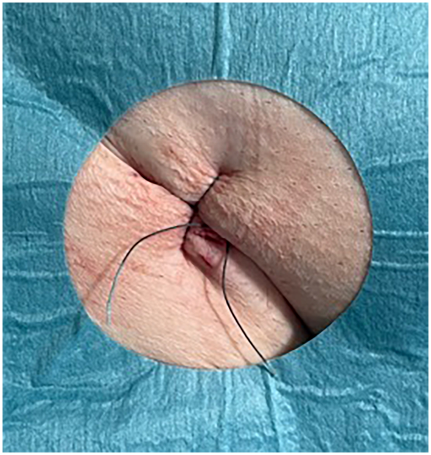 Surgical site with sutures on skin, surrounded by a blue sterile drape. The area is under bright light, showing fine details of the stitching work.
