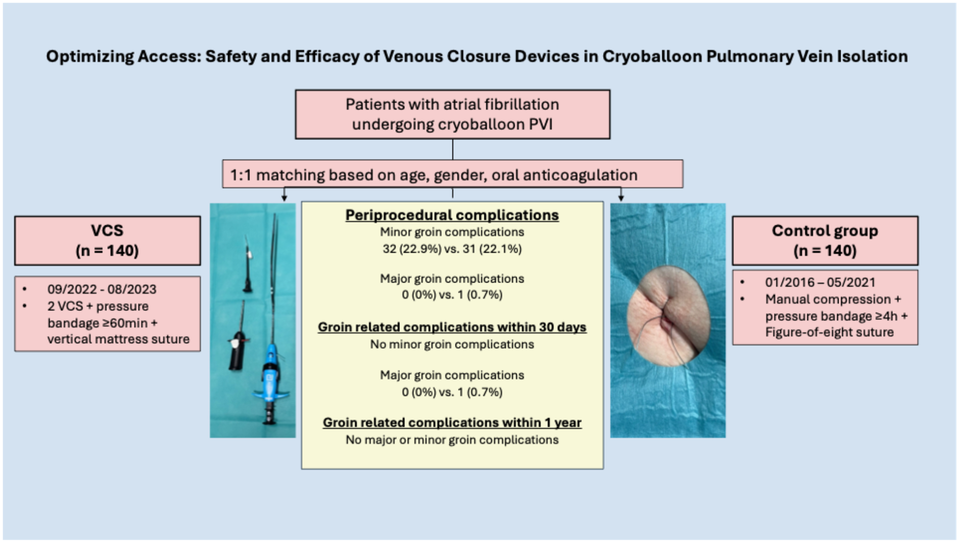 Infographic comparing safety and efficacy of venous closure devices (VCS) versus manual compression in 280 matched atrial fibrillation patients undergoing cryoballoon pulmonary vein isolation. Two groups of 140 patients each were matched 1:1 by age, gender, and anticoagulation use. The VCS group (2022–2023) received two venous closure devices, pressure bandage ≥60 minutes, and vertical mattress suture. The control group (2016–2021) received manual compression, pressure bandage ≥24 hours, and figure-of-eight suture. Periprocedural minor groin complications occurred in 22.9% (VCS) and 22.1% (control); major complications were absent in VCS and occurred in 0.7% of controls. No groin complications were reported within 30 days or 1 year in the VCS group.