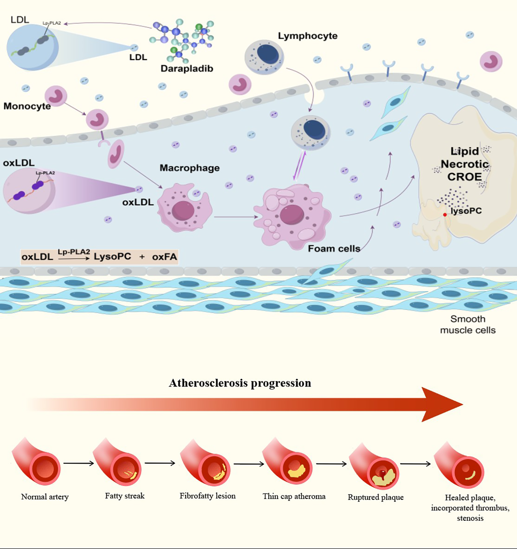 Diagram illustrating the process of atherosclerosis. At the top, LDL is oxidized into oxLDL, leading to monocyte conversion into macrophages and foam cells after interaction with lymphocytes. Lipid accumulation and necrotic core formation are shown. Below, an arrow indicates the progression from a normal artery to fatty streak, fibro-fatty lesion, thin-cap atheroma, ruptured plaque, and finally a healed plaque with thrombosis and stenosis, representing different stages of atherosclerosis development.