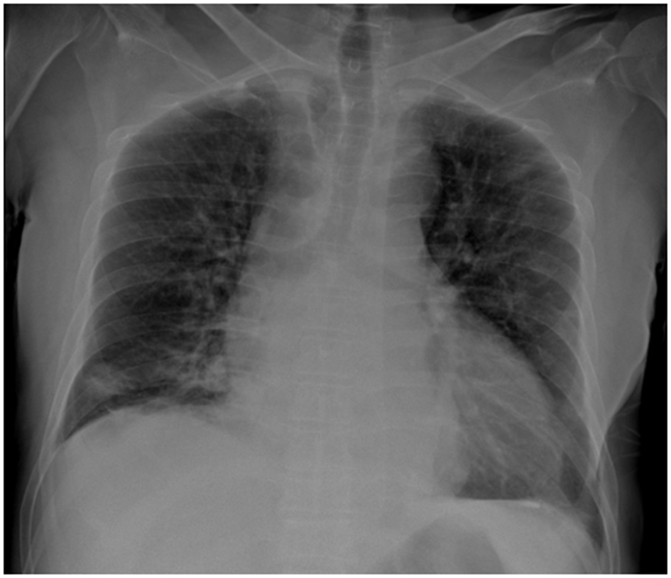 Chest X-ray showing the thoracic cavity, with visible lungs, heart, and surrounding structures. The images show standard imaging with differences in tissue density, aiding in medical diagnosis.
