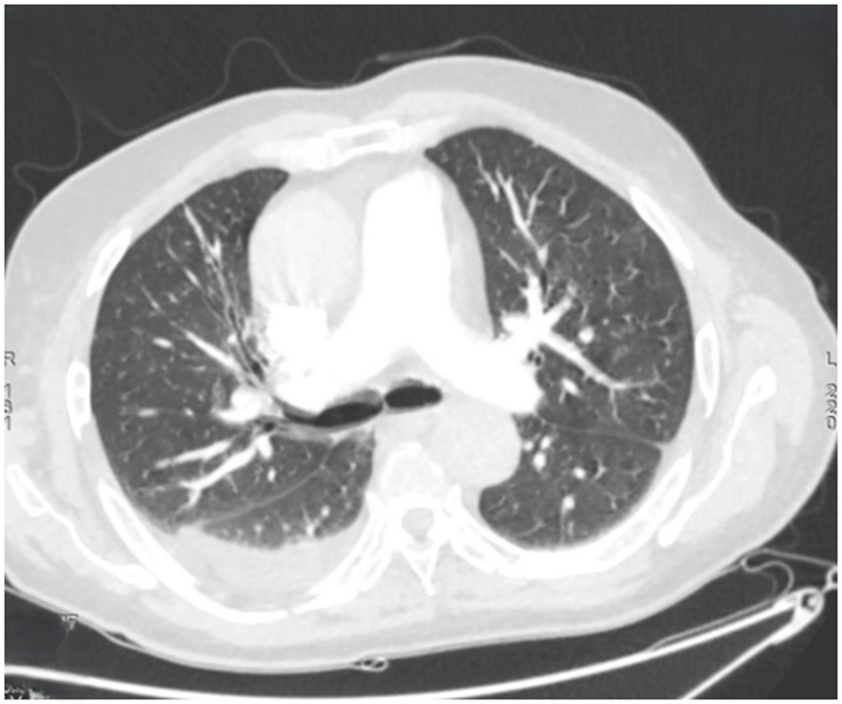 CT scan of a chest showing lung tissue with clear white branching structures, representing airways and blood vessels, set in a cross-sectional view of the thoracic cavity.