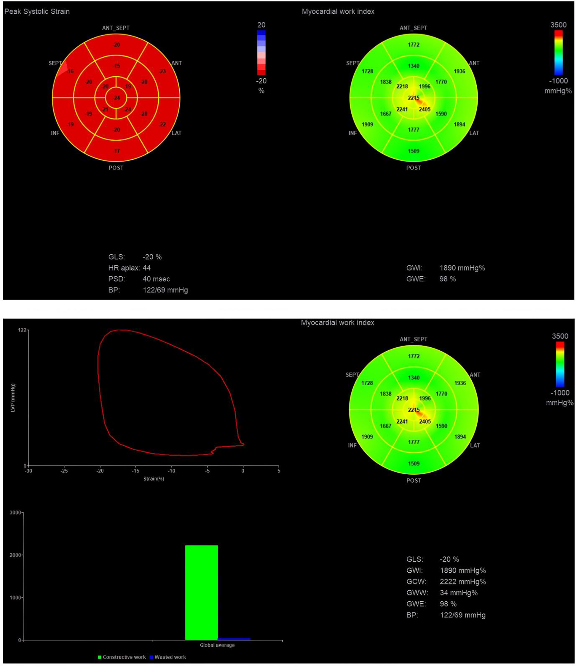 Peak Systolic Strain and Myocardial Work Index visualizations include circular diagrams and charts. The left shows a red strain bullseye pattern with color gradients for various heart sections, indicating strain from -20 percent to 20 percent. Below are key metrics like GLS: -20%, HR apex: 44, and BP: 122/69 mmHg. The right shows a green bullseye diagram detailing myocardial work index with GWI: 1890 mmHg%, GWE: 98%. A pressure-strain loop graph and a bar chart showing global average constructive work versus wasted work are also present.