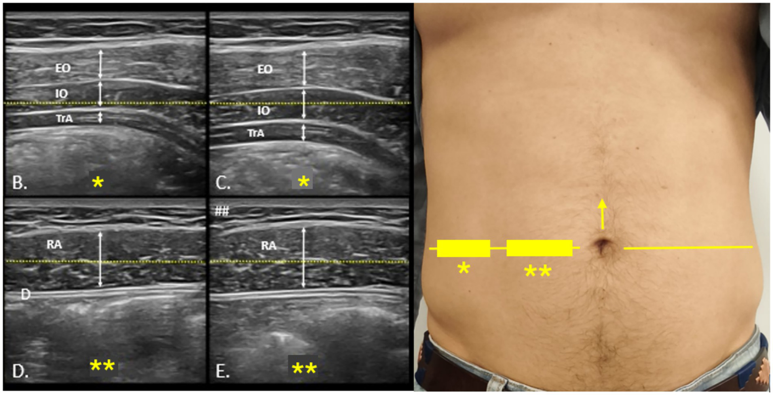 Four ultrasound images of the abdomen display muscle layers labeled as EO (External Oblique), IO (Internal Oblique), TrA (Transversus Abdominis), and RA (Rectus Abdominis). Yellow lines and asterisks highlight specific areas or references. Adjacent is a photo of an abdomen marked with yellow lines pointing to various parts, providing a contextual correlation with the ultrasound images.