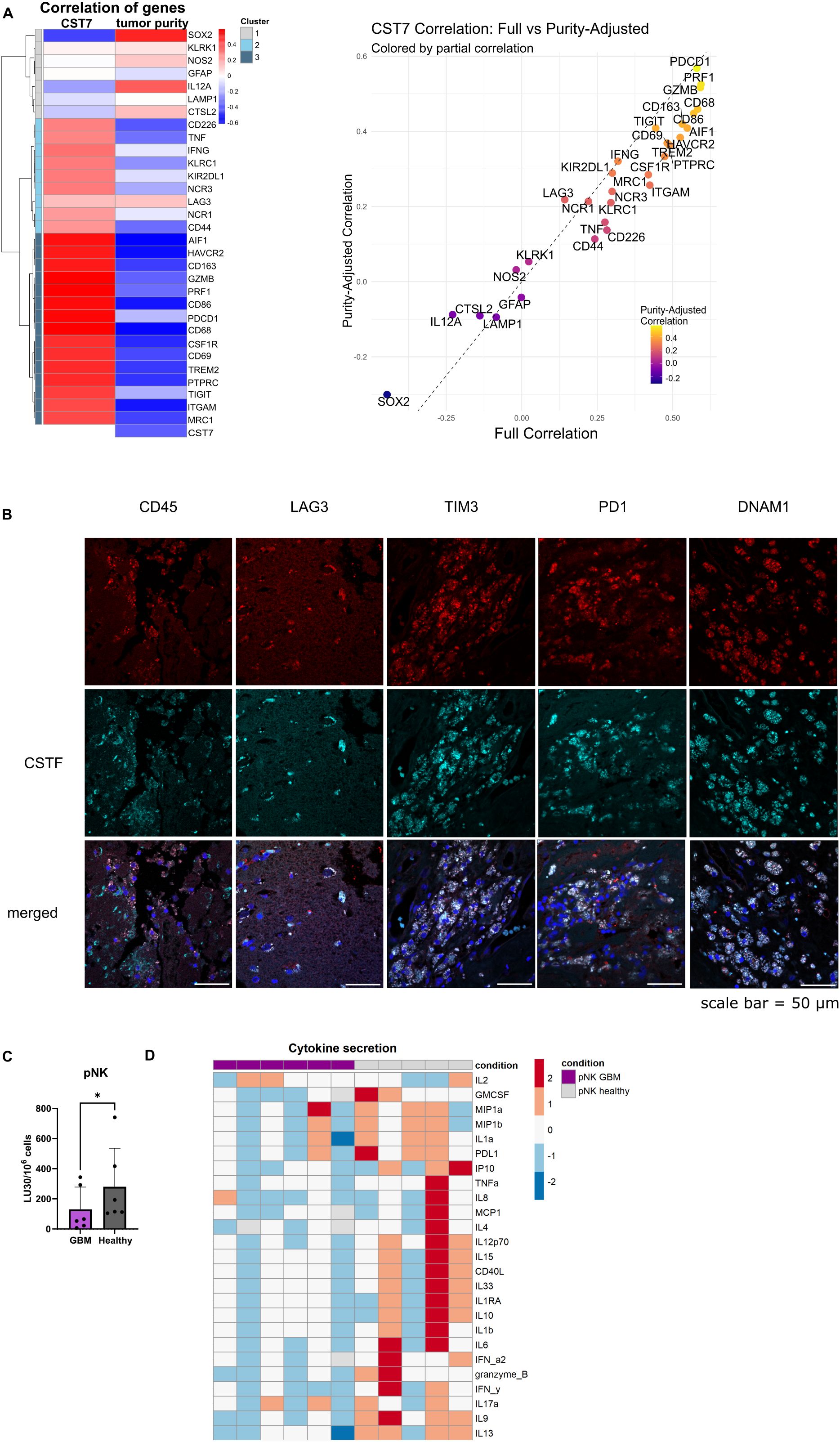 Panel A displays a heatmap and scatter plot illustrating gene correlations with CST7 and tumor purity. Panel B shows fluorescence images of tissue stained with CD45, LAG3, TIM3, PD1, and DNAM1, with merged images including CSTF. Panel C presents a bar chart comparing pNK cytotoxicity between GBM and healthy samples, highlighting significant differences. Panel D features a heatmap of cytokine secretion comparing pNK between GBM and healthy donors' samples, with varying color intensities indicating concentration levels. Scale bar in images is equal to fifty micrometers.