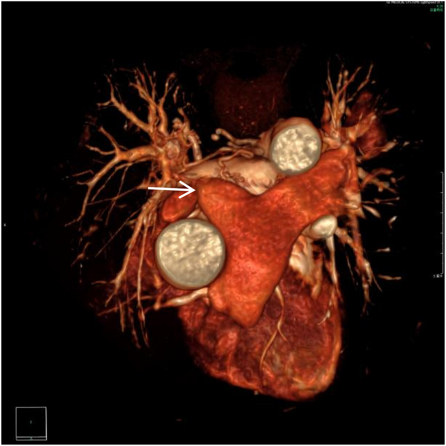 A 3D medical imaging scan highlighting the heart and surrounding structures. The arrow points to a specific area, possibly indicating a notable feature or concern. Blood vessels are visible branching out from the heart.