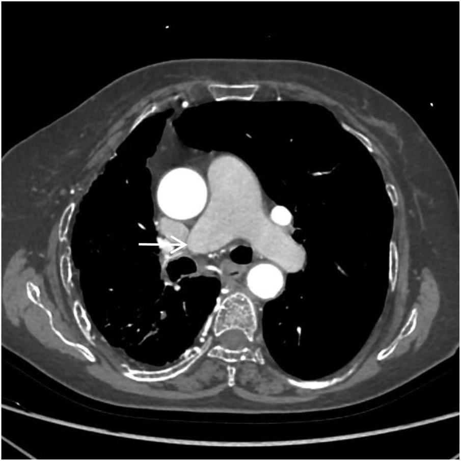 CT scan of the chest showing a cross-sectional view of the thorax. An arrow indicates a specific area near the heart and major blood vessels, highlighting an abnormality or point of interest.