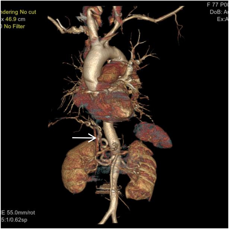 Three-dimensional medical imaging of an abdominal aorta aneurysm with a marked arrow pointing to the affected area. The image highlights vascular structures and organs for diagnostic purposes.