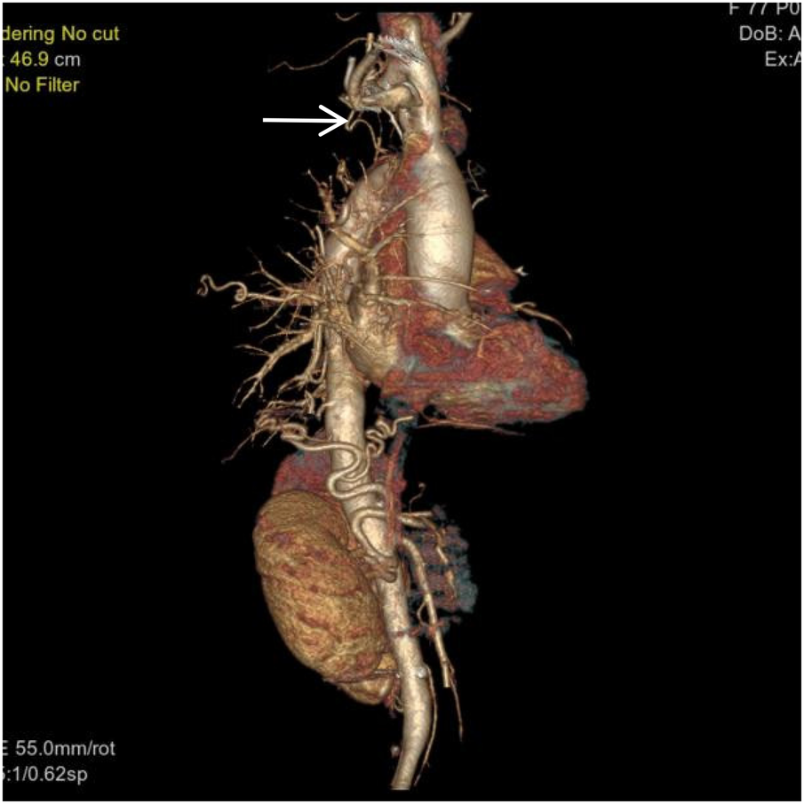 CT angiogram showing an branching in the subclavian artery. The subclavian artery and branching arteries are visible, with the branching indicated by an arrow. The surrounding tissue is colored to highlight anatomical structures.