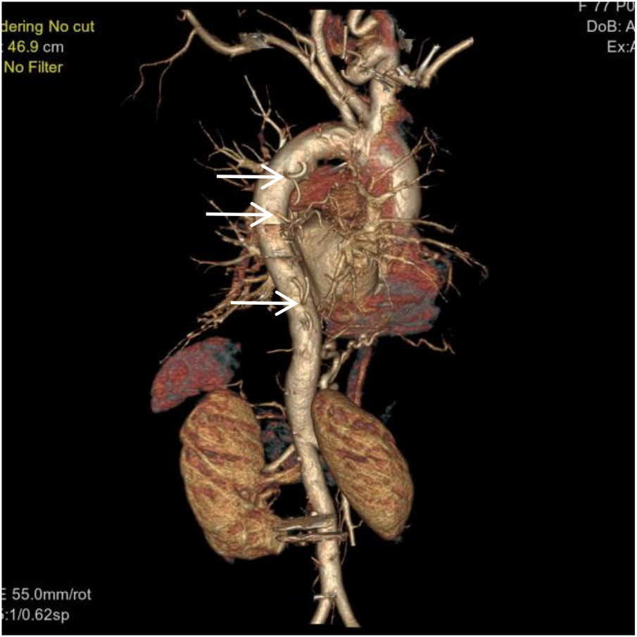CT angiogram showing a detailed 3D view of the thoracic aorta, highlighting Intercostal artery and its branches. Arrows point to the dissection area. Lungs and surrounding vessels are partially visible.