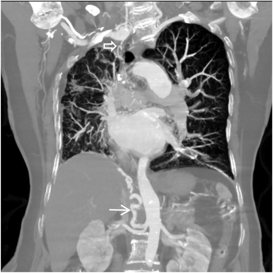 CT scan of the chest showing the heart, lungs, and major blood vessels. Two arrows point to different areas, suggesting areas of interest or concern. The lungs display branching patterns typical of blood vessels.
