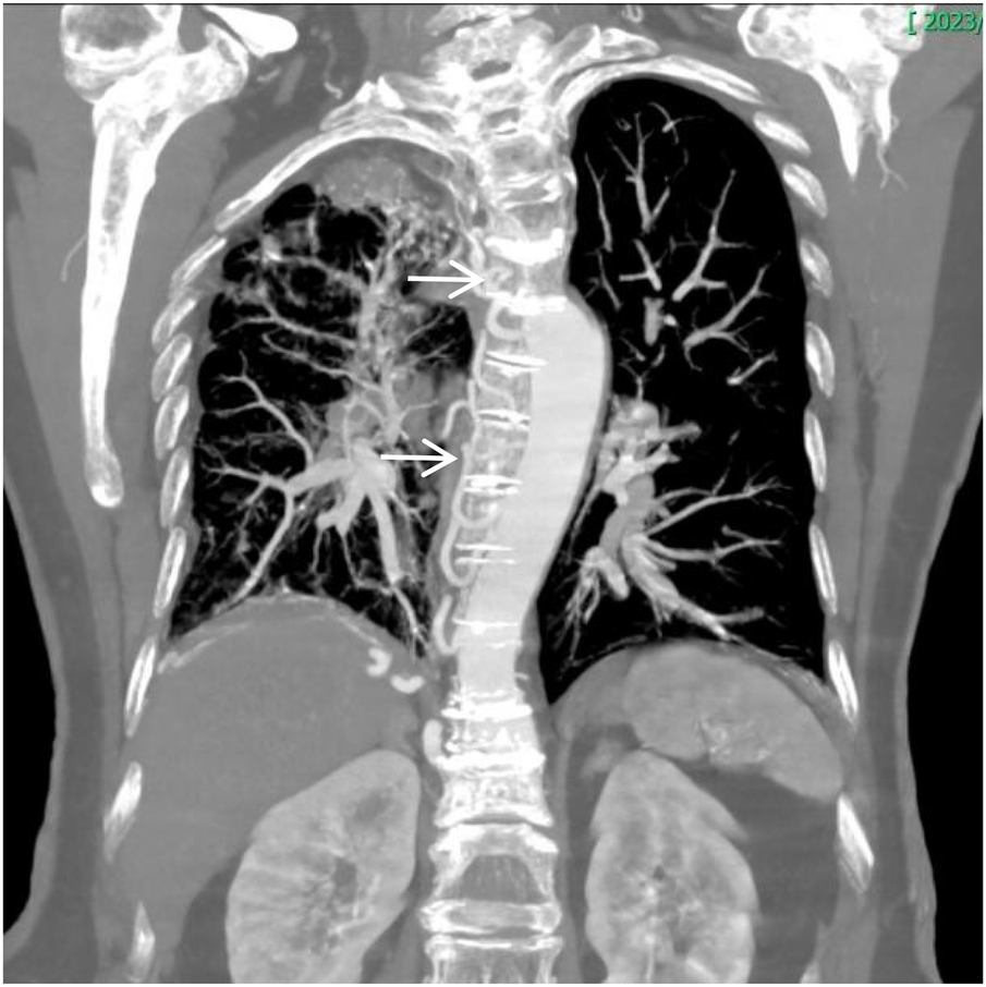 CT scan of a human thorax displaying the lungs, spine, and surrounding tissues. Two arrows point to the origins of the intercostal arteries, indicating regions of interest. The bronchial branching is clearly visible.