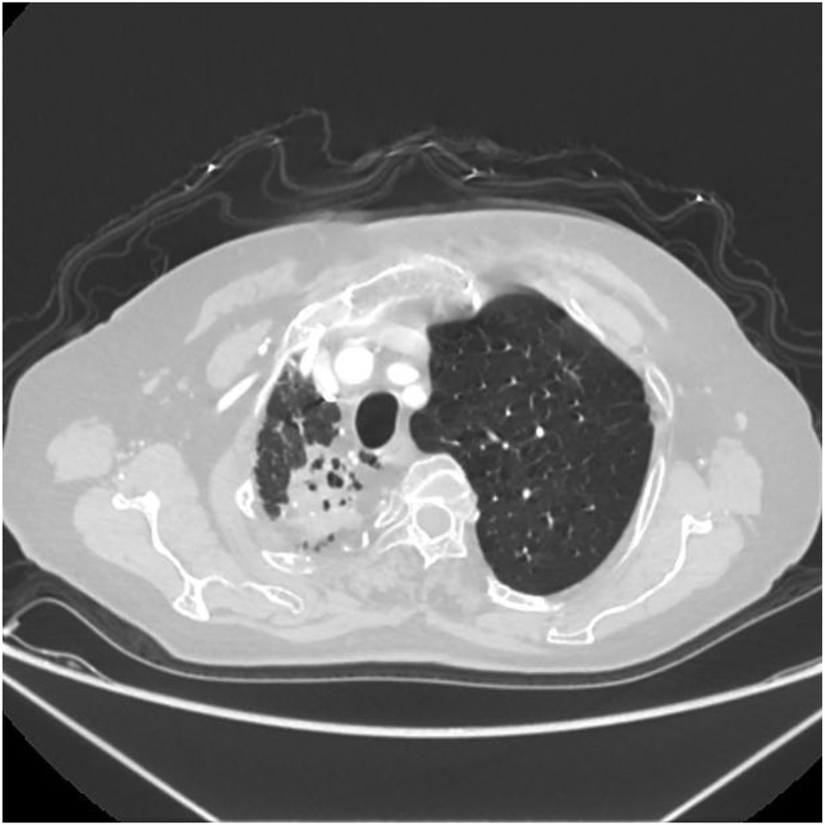 CT scan image showing an axial cross-section of the chest. The left lung appears enlarged and darker, possibly indicating hyperinflation or consolidation, while the right side shows varied densities and patterns, suggesting potential abnormalities. Surrounding tissues and structures are visible.