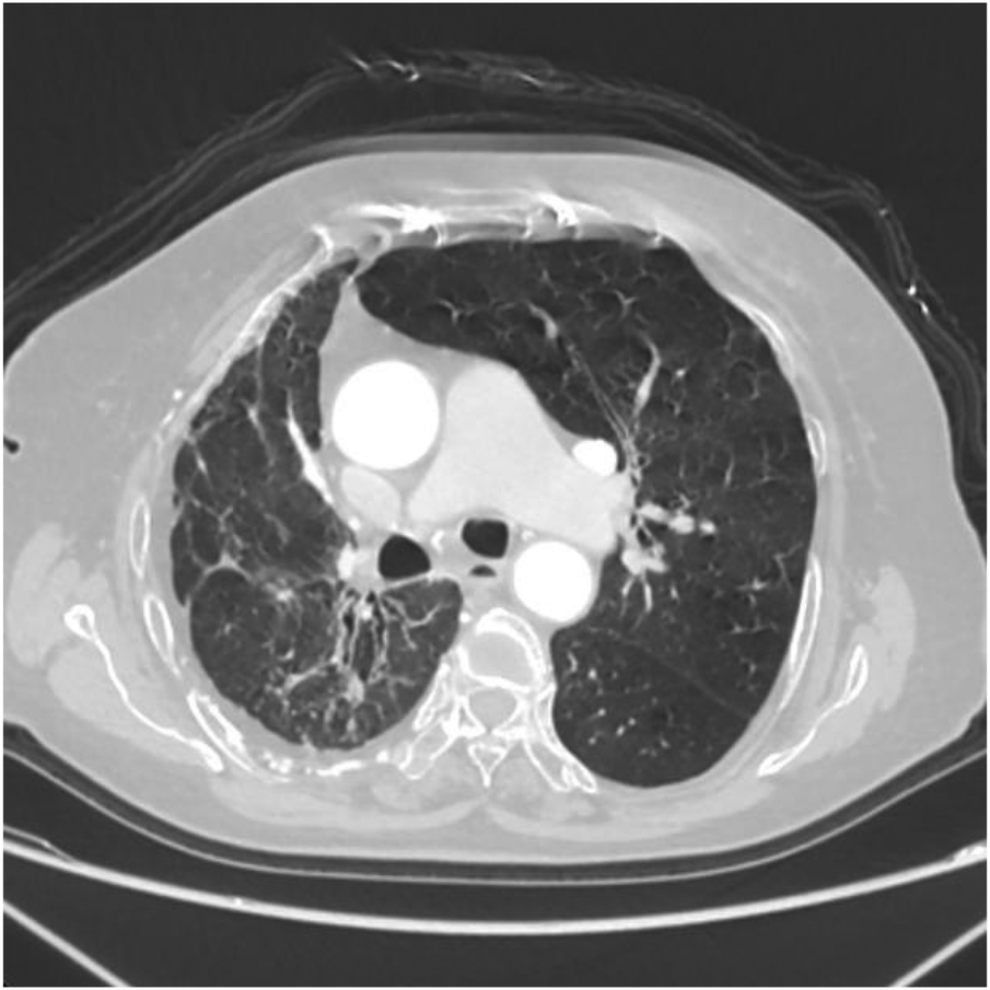 CT scan of a chest showing a cross-sectional view of the lungs. The image reveals areas with possible abnormalities, including irregular darker sections suggesting varied lung density. Bright areas indicate bones and other tissues.