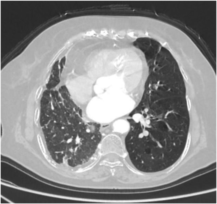 CT scan of a human chest showing the lungs, heart, and surrounding structures. The image highlights differences in tissue density, with darker areas representing air-filled spaces in the lungs and lighter areas indicating denser tissues like bones and heart.