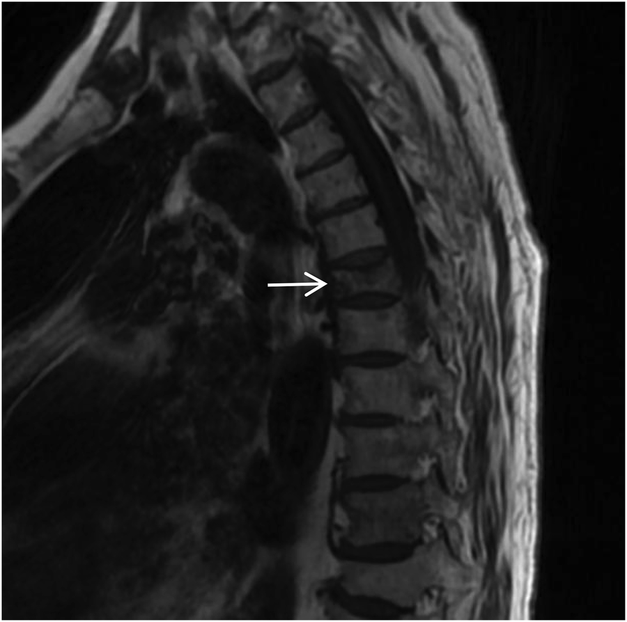 MRI scan showing a sagittal view of the thoracic spine. An arrow marks a specific vertebral location, suggesting potential abnormality or area of interest.