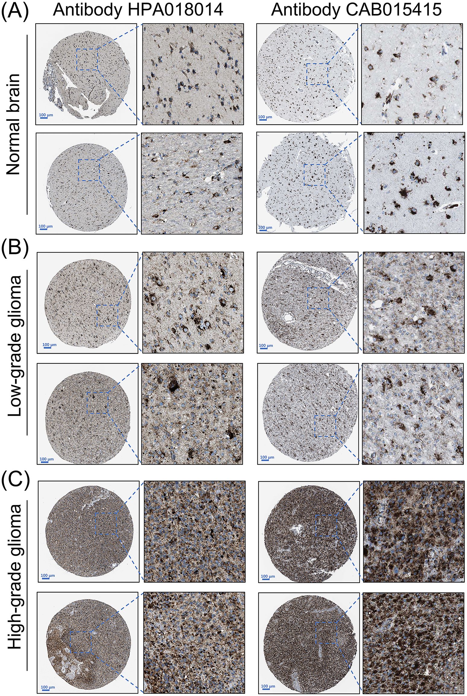 Histological comparison of normal brain, low-grade glioma, and high-grade glioma tissues using two antibodies, HPA018014 and CAB015415. Each section contains magnified areas to show cellular details and staining differences. The images exhibit varying levels of staining intensity and cell density across the three tissue types, illustrating the differential expression detected by the antibodies.