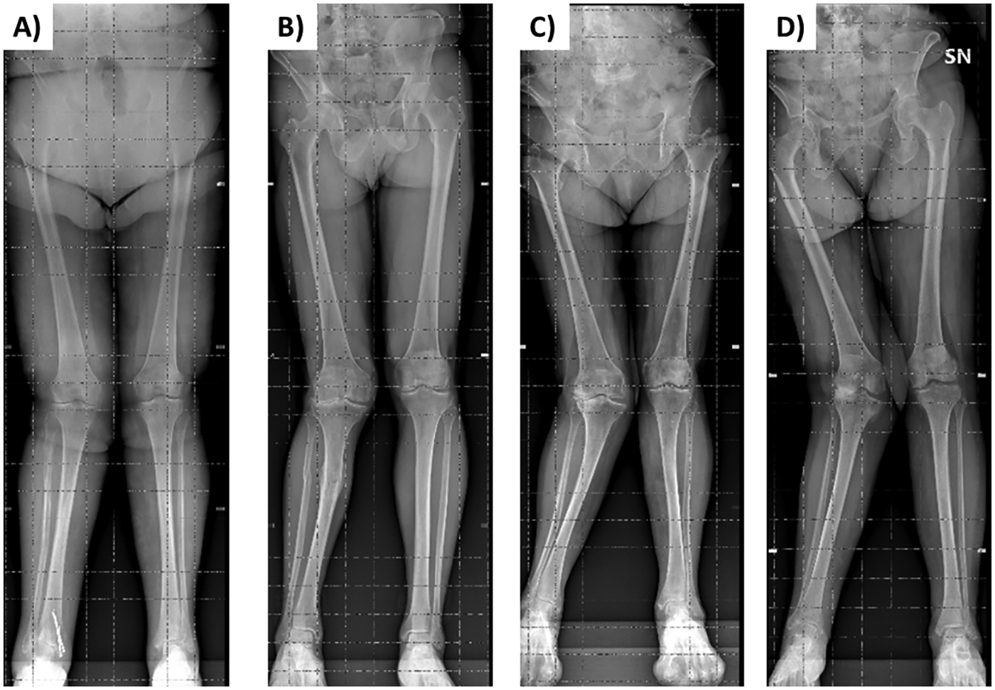 Four X-ray images labeled A to D show the alignment of the legs and hips. Each image displays different positions or angles, illustrating variations in bone structure and alignment. The hips, knees, and lower legs are the focus, with markings for measurement purposes.