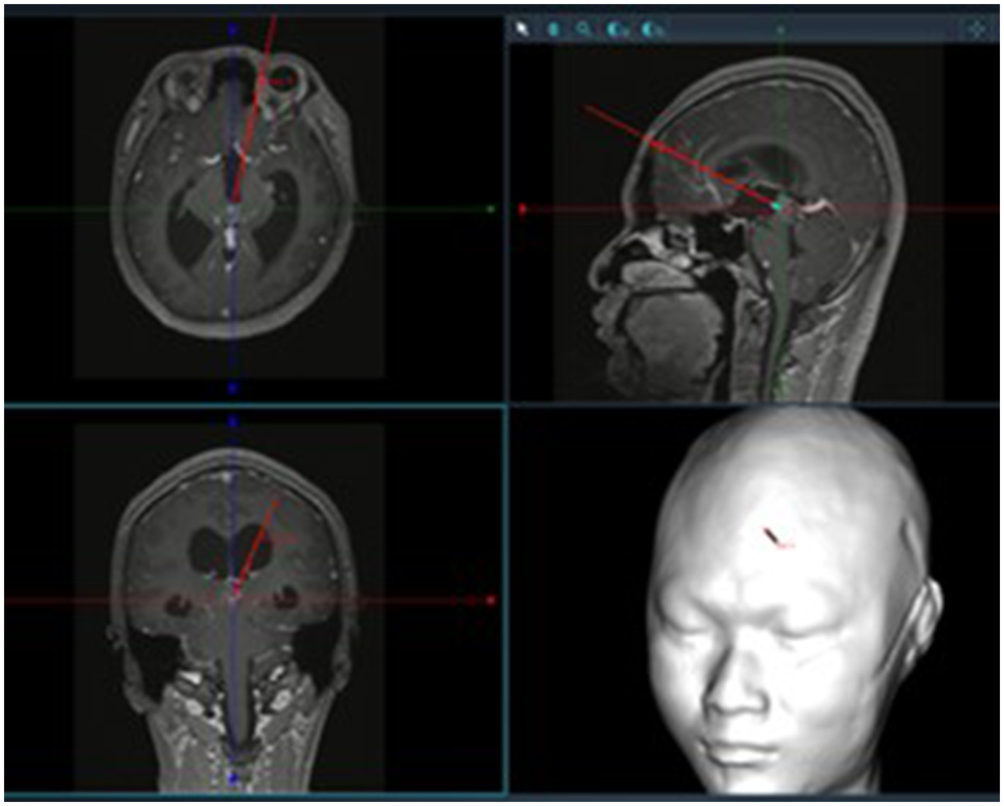 Three-dimensional preoperative neuronavigation view illustrating the surgical trajectory from the frontal bone to the pineal region through the lateral ventricle and foramen of Monro.