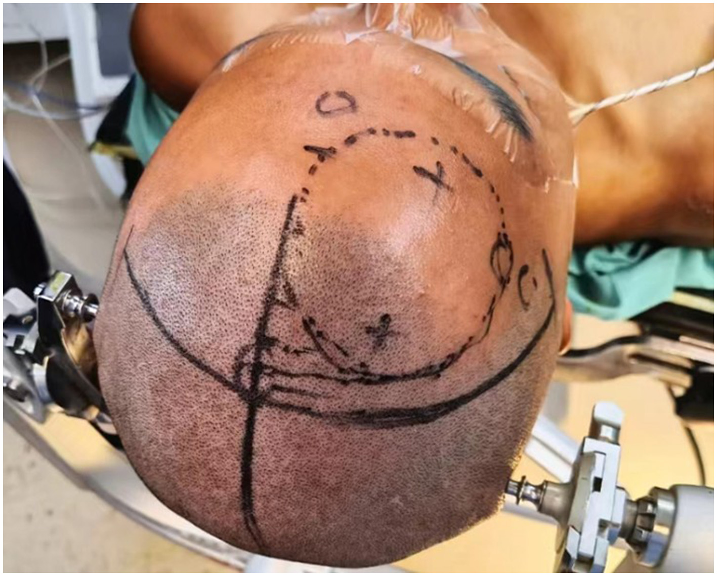 Diagram showing the location of burr holes for tumor resection and third ventriculostomy on the frontal scalp.