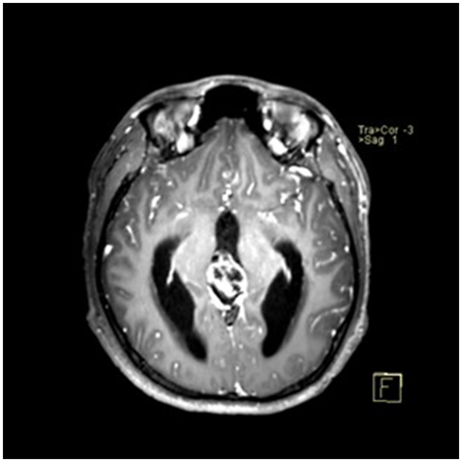 Axial contrast-enhanced MRI showing a cystic-solid pineal region tumor with supratentorial hydrocephalus.