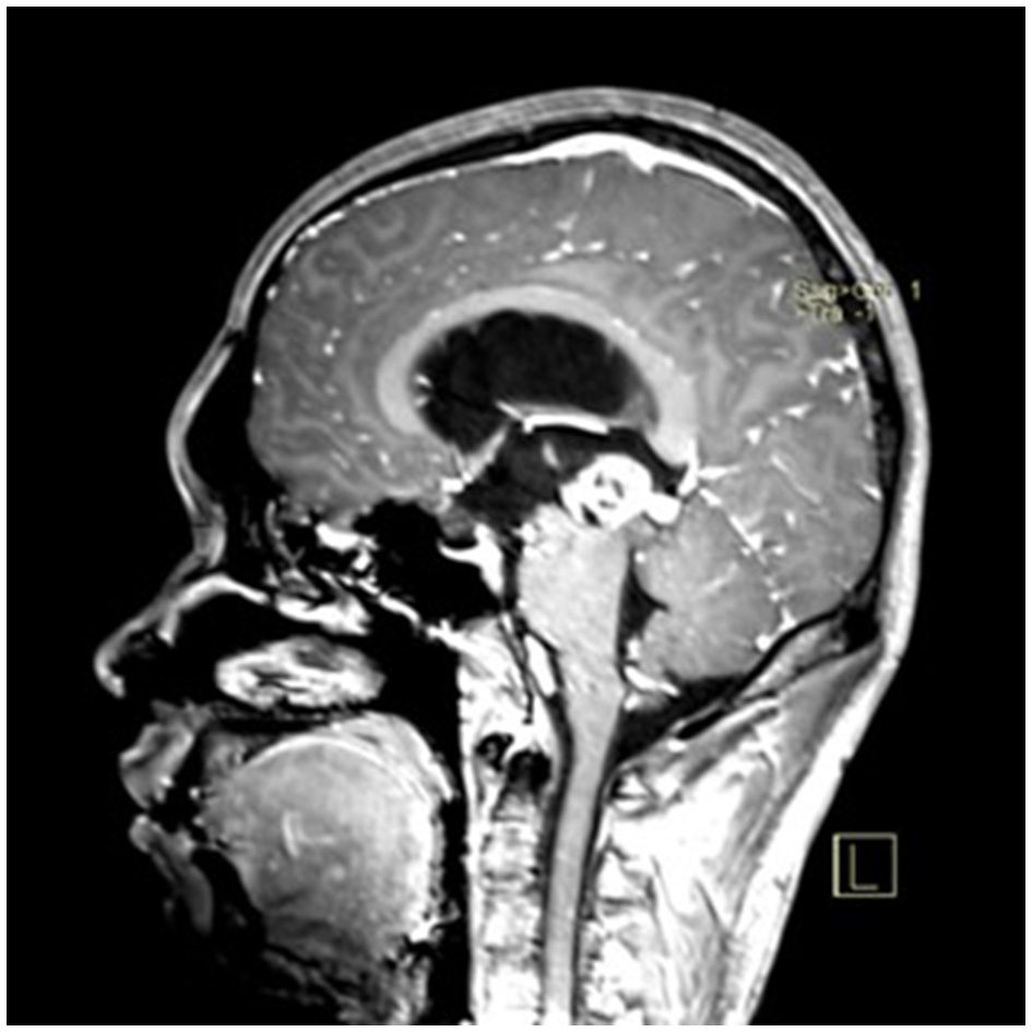 Axial postoperative MRI showing complete tumor removal and reduced hydrocephalus.