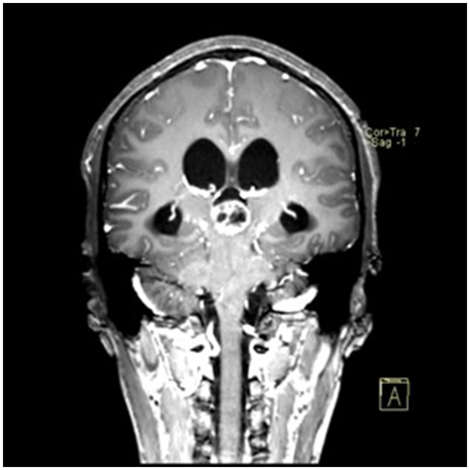 Sagittal contrast-enhanced MRI showing a pineal region tumor compressing the tectal plate and aqueduct.