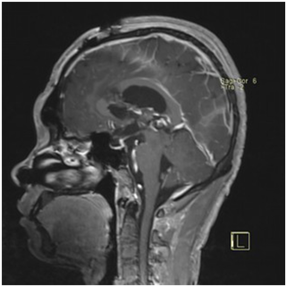 Sagittal postoperative MRI showing no residual tumor and normalized ventricles.