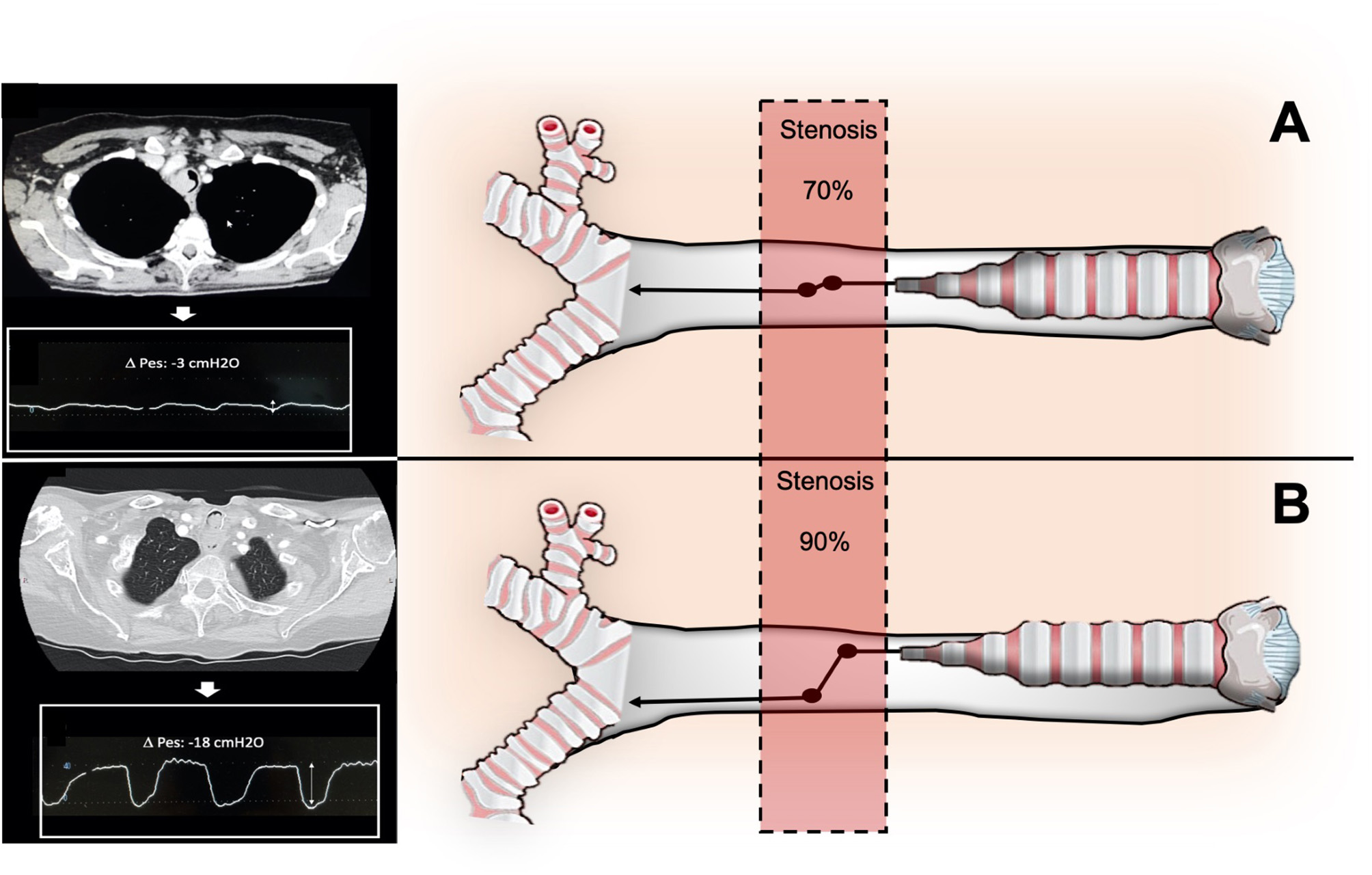 CT images and diagrams showing tracheal stenosis at 70% (Panel A) and 90% (Panel B). Each panel includes a lateral diagram of the trachea with marked stenosis and intrathoracic pressure waveforms, with pressure values at -3 cm H2O and -18 cm H2O respectively.