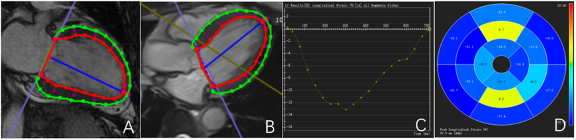 Four-panel image of a heart analysis. Panel A: MRI showing heart segmentation with red and green outlines. Panel B: Side view of the heart with similar outlines. Panel C: Graph displaying longitudinal strain over time with a downward curve. Panel D: Bullseye plot showing peak longitudinal strain values with varying shades of blue and yellow, indicating different strain levels.