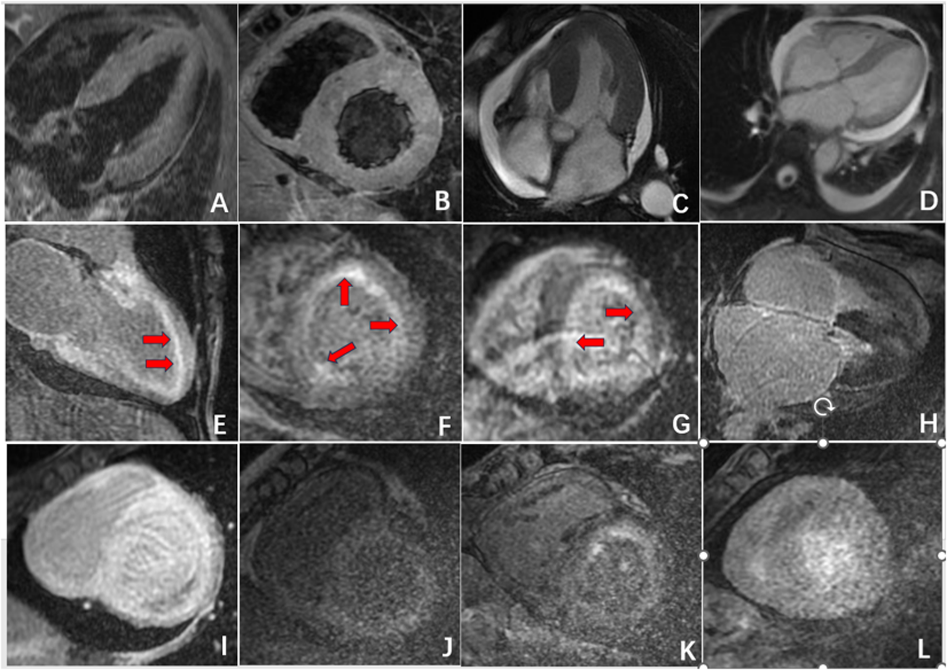 A series of twelve cardiac MRI images labeled A to L, showing various cross-sectional views of the heart. Images E, F, and G have red arrows pointing to specific areas within the heart structures, possibly highlighting regions of interest or abnormalities. The grayscale images capture different anatomical perspectives and potential pathologies for diagnostic purposes.