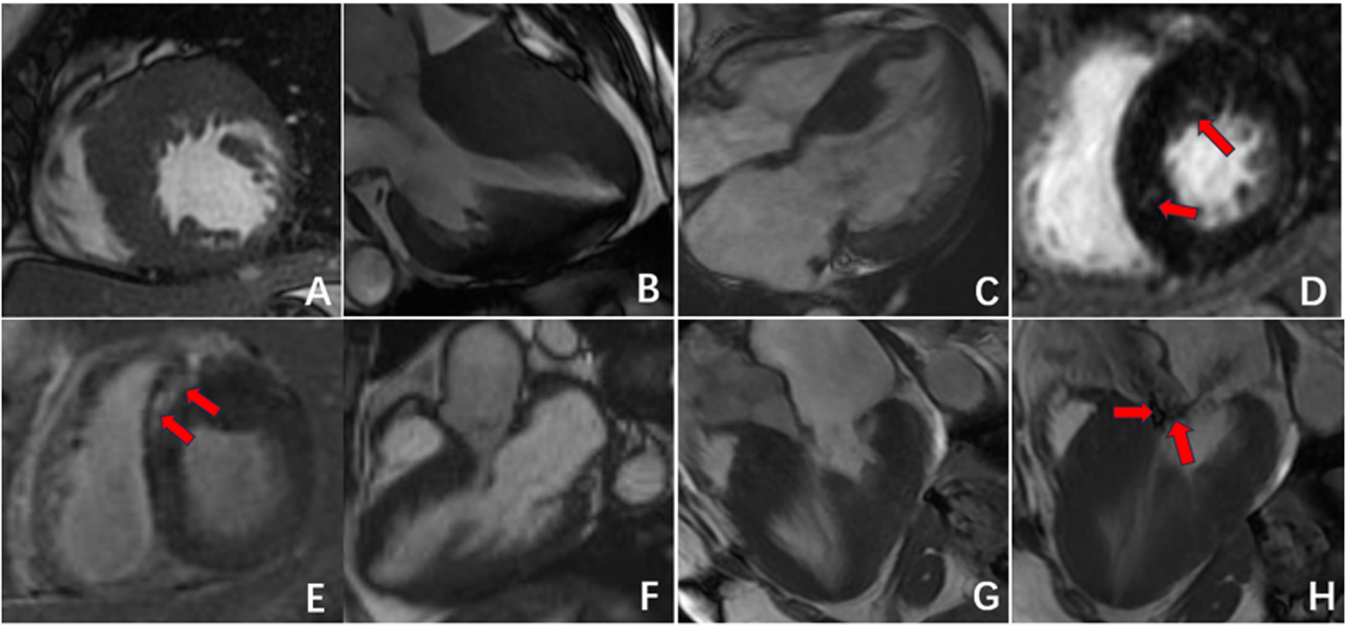 MRI images of the heart showing various abnormalities with red arrows highlighting areas of interest. Panel A shows a bright region indicative of a potential abnormality. Panel B and C display grayscale variations. Panel D and E indicate areas with arrows pointing to dark and light contrasts, suggesting possible pathologies. Panel F shows heart chambers. Panel G displays heart muscle. Panel H highlights a specific area with arrows pointing at possible irregularities within the heart structure.
