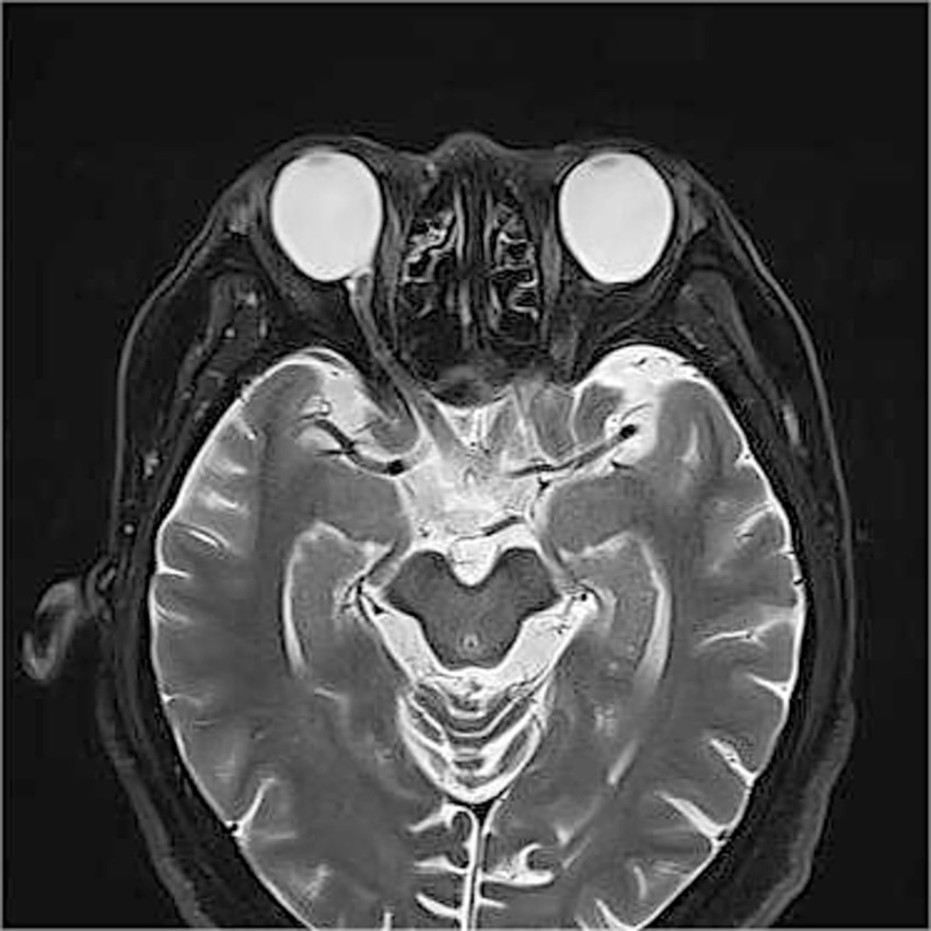 Orbital MRI demonstrates axial elongation with posterior staphyloma in both eyes. Only a single optic nerve is identifed posterior to each globe.