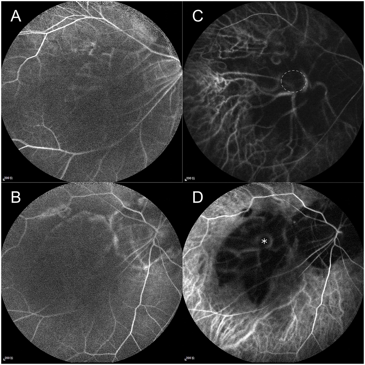 Fluorescein and indocyanine green angiography (FFA & ICGA) of the right eye. FFA: (A) Early phase (24 s) shows retinal vessels at the optic disc but not within the pit. (B) Late phase (3 min 35 s) reveals optic disc hyperfluorescence, contrasting with the non-fluorescent pit. ICGA: (C) Early phase (20 s) demonstrates short posterior ciliary arteries originating from the pit (outlined by a white circle). (D) Late phase (3 min 35 s) shows ring-shaped staining along the pit margin.