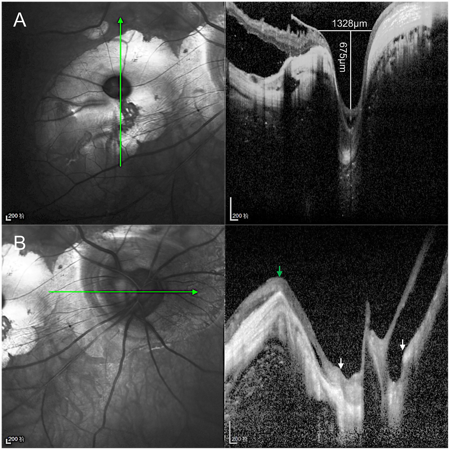 OCT image comparing a disc-like pit and the true optic disc. (A) The disc-like pit is situated within a posterior staphyloma, forming a focal deep excavation (1328 μm wide, 675 μm deep) with thinned sclera, absent choroid, and retinoschisis at its base and margin. (B) The true optic disc lies at the bottom of a peripapillary staphyloma, accompanied by a temporal scleral ridge, nasal retinoschisis, and a shallower, flatter excavation than the disc-like lesion.