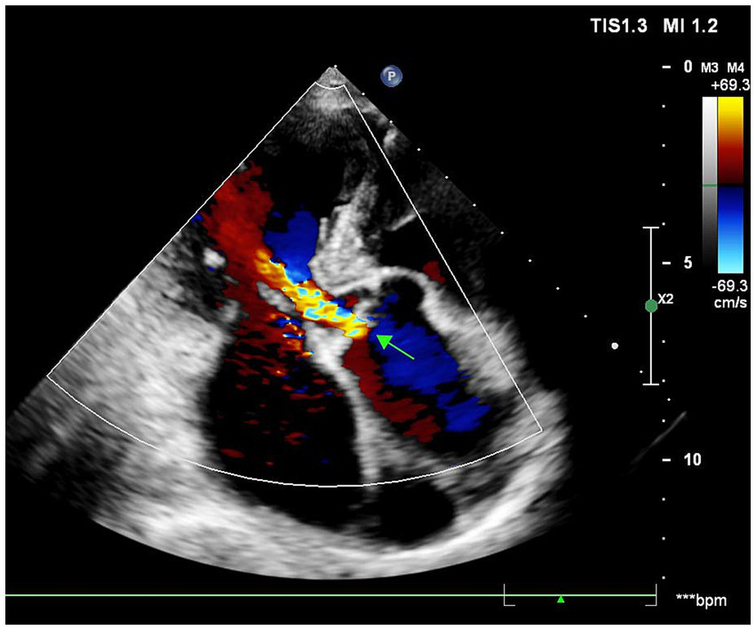 Transthoracic echocardiogram with Doppler imaging. The image shows a thickened aortic valve with restricted opening. Color Doppler reveals a wide, turbulent jet of moderate aortic regurgitation (in blue), originating from the aortic valve and extending into the left ventricular outflow tract. A green arrow annotates the vena contracta of the regurgitant jet. A velocity scale is present on the side.