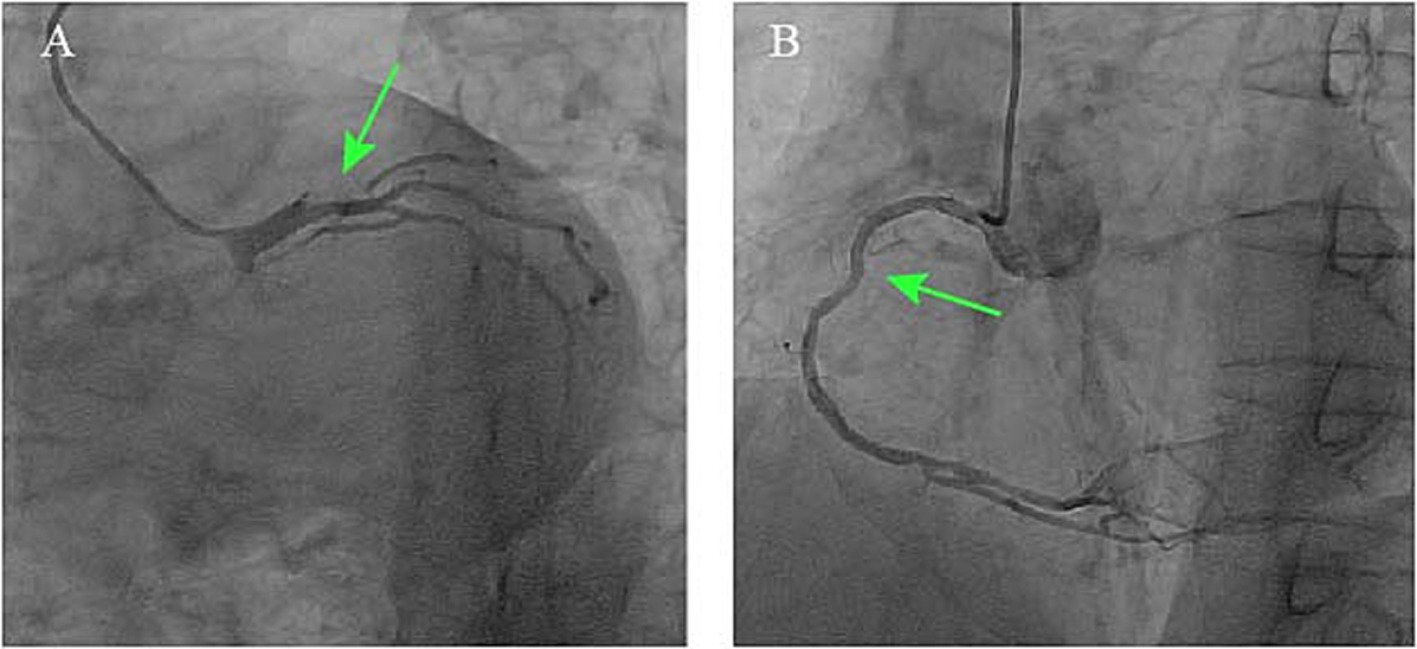 Coronary angiograms in two panels. Panel A (Right Anterior Oblique view with Caudal angulation) shows a critical, discrete stenosis at the ostio-proximal segment of the left anterior descending artery (green arrow). Panel B (Left Anterior Oblique view) demonstrates diffuse disease in the right coronary artery and the presence of Rentrop grade 2 collateral circulation (green arrow) bridging from the right to the left coronary system.