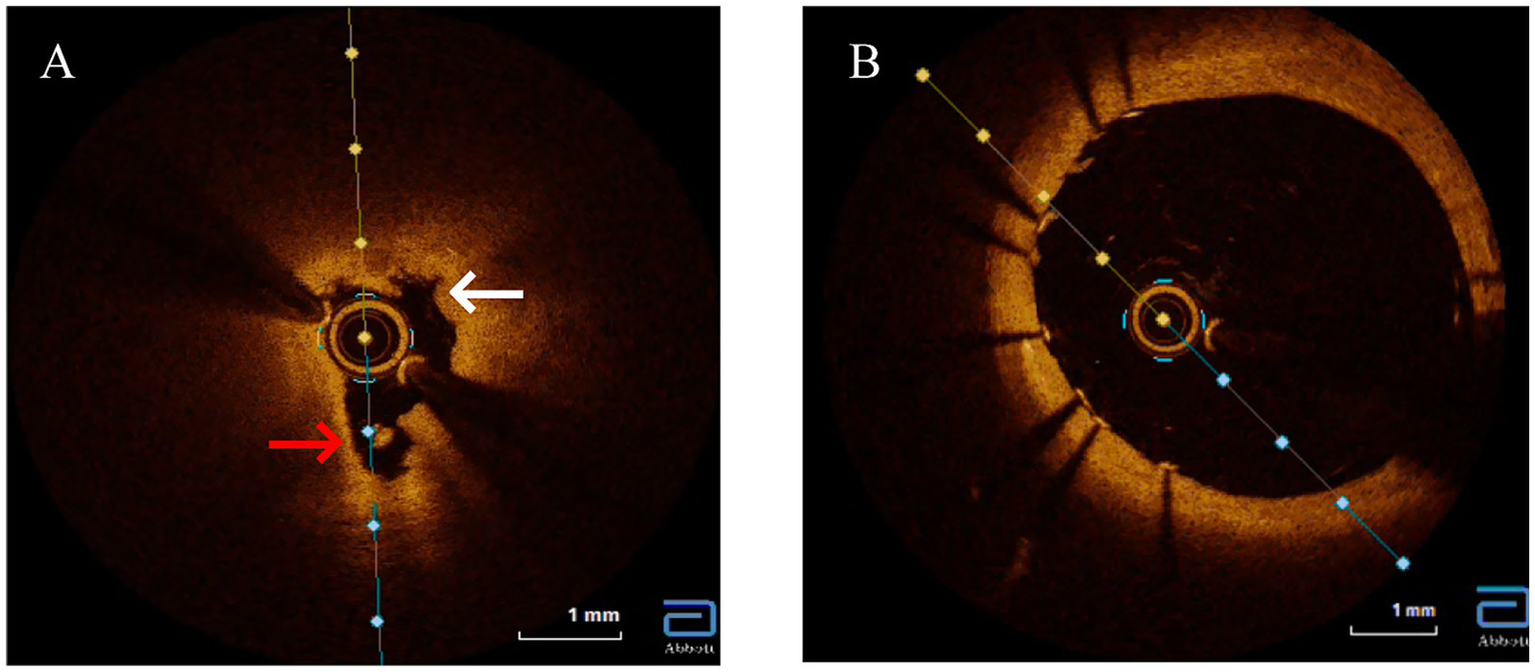 Optical coherence tomography (OCT) cross-sections of the left main coronary ostium. Image A pre-intervention reveals severe luminal narrowing, marked medial layer disruption (white arrows), and pathognomonic hyporeflective adventitial microcalcifications (red arrows). The vasa vasorum are obliterated. Image B post-intervention shows a well-expanded and apposed drug-eluting stent, with its metallic struts visible as bright dots, fully scaffolding the vessel and restoring a patent lumen. A 1 mm scale bar is provided.