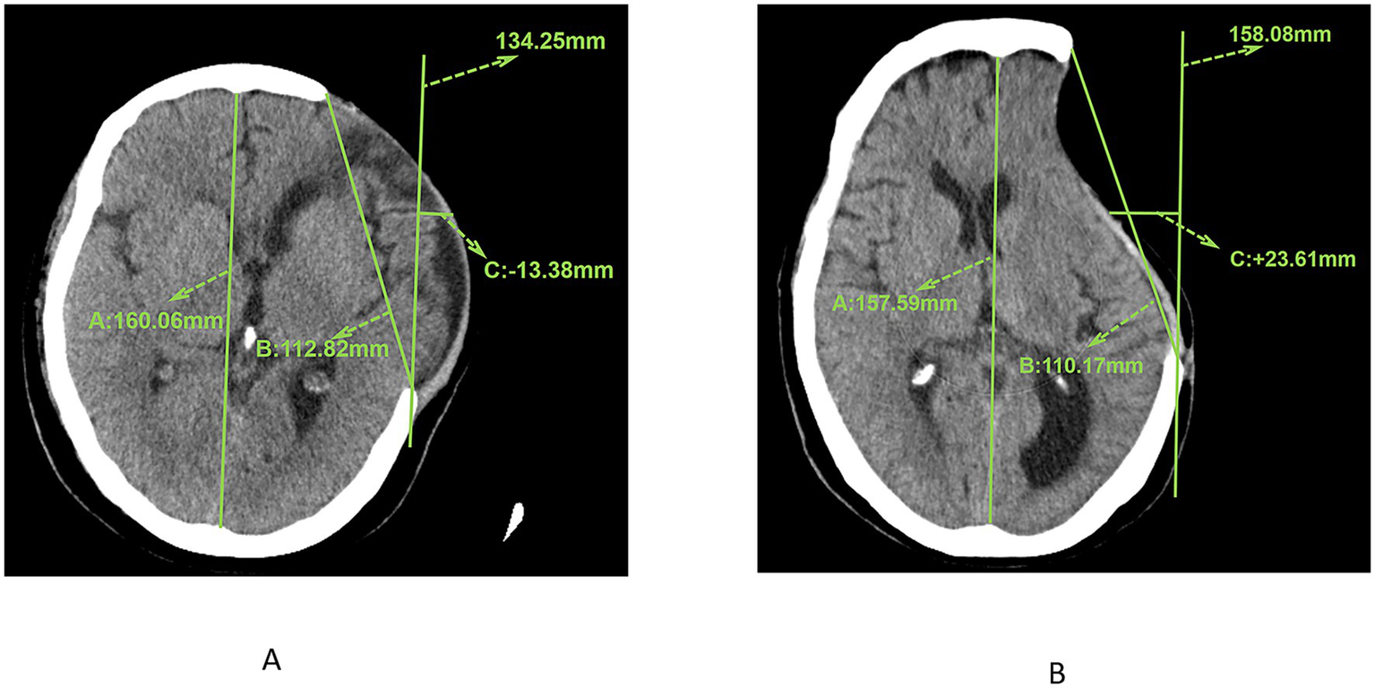 CT scans showing two axial brain images labeled A and B. Both images include measurements in millimeters: A has measurements of 160.06 and 112.82 with a difference of -13.38; B shows 157.59 and 110.17 with a difference of +23.61. Green lines and arrows indicate measurement points.