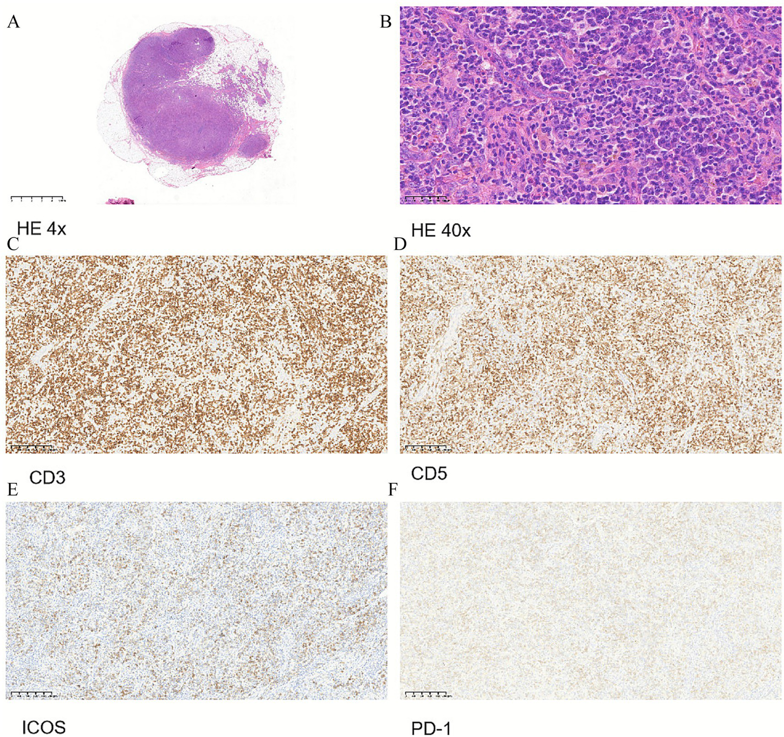 Panel A shows a low magnification view stained with Hematoxylin and Eosin (HE) at 4x, displaying an overview of a tissue sample. Panel B provides a higher magnification, HE 40x, highlighting cellular details. Panels C and D illustrate immunohistochemical staining for CD3 and CD5, respectively, with widespread brown staining indicating protein expression. Panel E shows ICOS and panel F displays PD-1 immunostaining with lighter staining patterns. Each image includes a scale bar for reference.